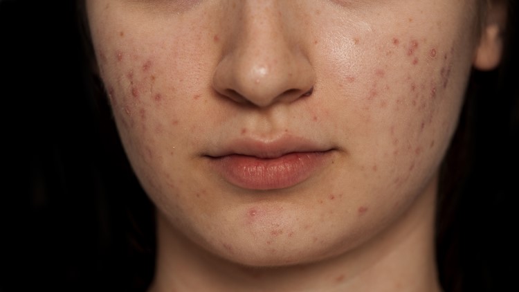 Close up of girl with problematic skin